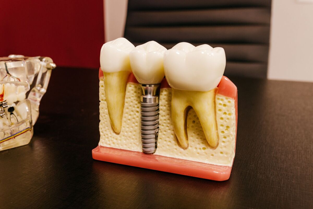 Dental implant model used in patient education